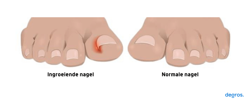 Nagels informatie Camathé Medisch Pedicure Enschede